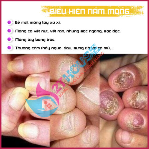 kem trị nấm tay thái lan