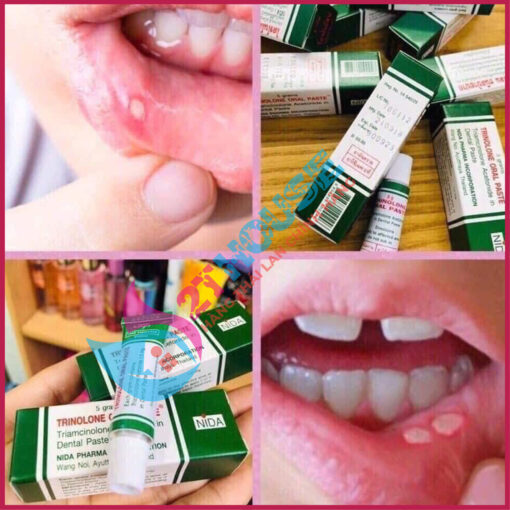 Kem bôi nhiệt miệng Trinolone Oral Paste Nida Thái Lan